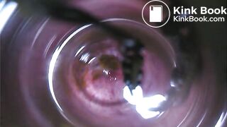 Observation　Inside Anus