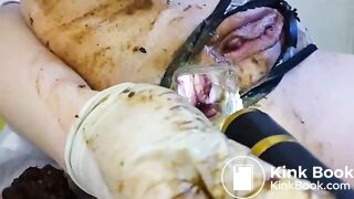 speculum