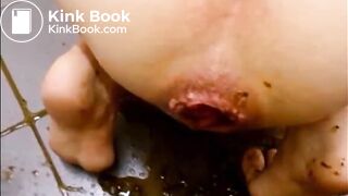 Girl shitting a big plug and diarrhea from her prolapsed anus