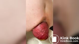 Prolapse2
