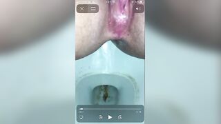 constipated hard poop