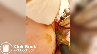 Scat urethra until anal urination