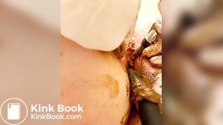 Scat urethra until anal urination