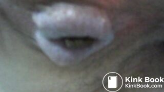 My asscunt swelling and shitting