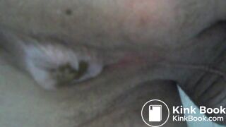 My asscunt swelling and shitting