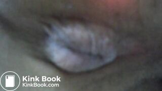 My asscunt swelling and shitting