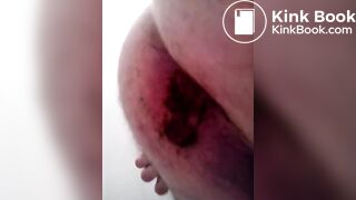 Shit coming out of my hole