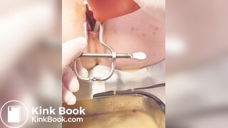 Urine sample at gynecology part 2/B