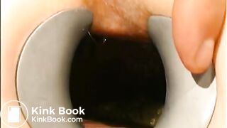 gynecologist find scat