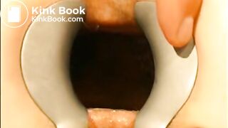 gynecologist find scat