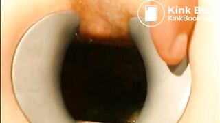 gynecologist find scat