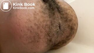 Prolapse