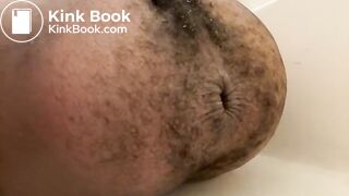 Prolapse