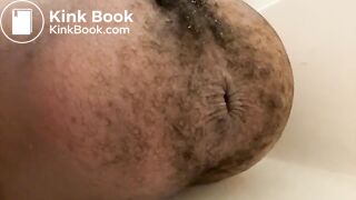 Prolapse