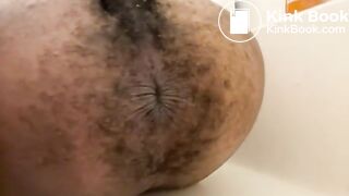 Prolapse