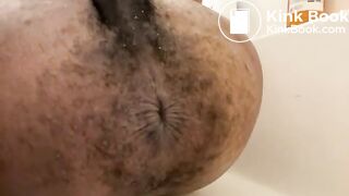 Prolapse