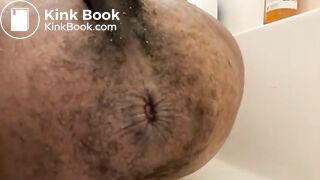 Prolapse