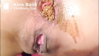 Girl Anal Speculum Shit