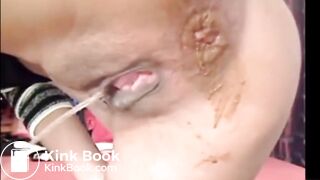 Girl Anal Speculum Shit