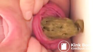 Prolapse scat - video 10