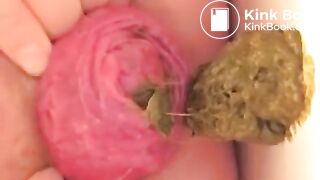 Prolapse scat - video 10