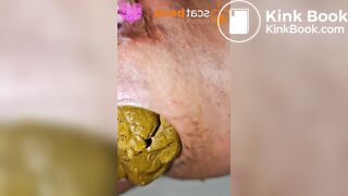 Mega constipation feeding prolapse