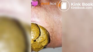 Mega constipation feeding prolapse