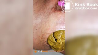 Extreme prolapse huge close up shit