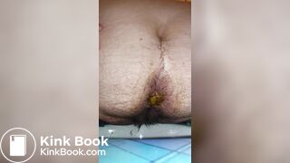 Extreme liquid diarrhea