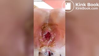 Mature Scar Ven