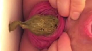 real prolapse girl pooping