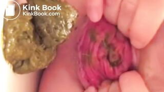 real prolapse girl pooping