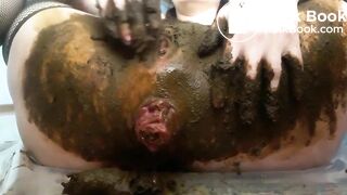 Prolapsed scat..