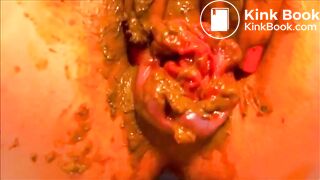 Poopy prolapse..