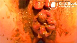 Poopy prolapse..