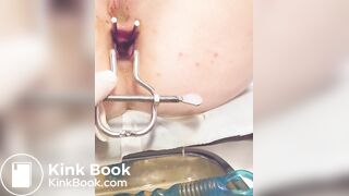 Urine sample at gyno p. 2/2B