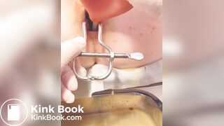 Urine sample at gyno p. 2/2B