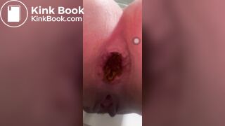 Constipation - video 12