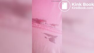 Marshmallow diarrhea eruption