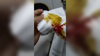 Chinese doctor diarrhea part3