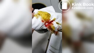 Chinese doctor diarrhea part3