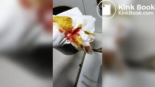 Chinese doctor diarrhea part3