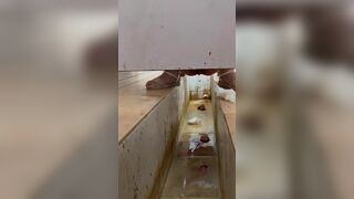 Chinese girl with large amount of diarrhea