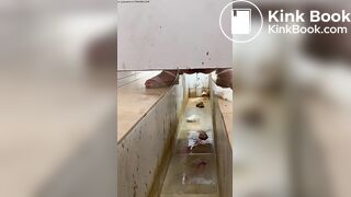 Chinese girl with large amount of diarrhea