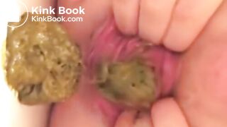 Prolapse Pro (Closeup)