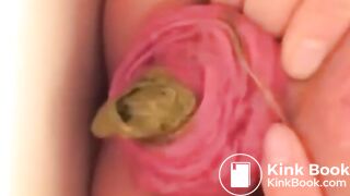 Prolapse Pro (Closeup)