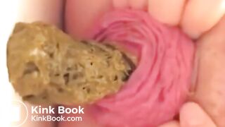 Prolapse Pro (Closeup)