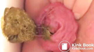 Prolapse Pro (Closeup)