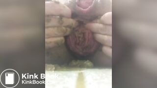 prolapse and shit 32