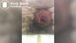 prolapse and shit 32